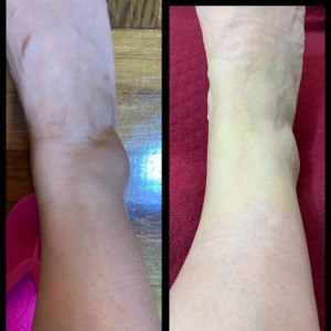 運動過勞，搞到腳踝受傷了！