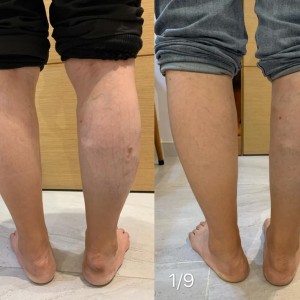 腿部青筋浮現 (中國市場)