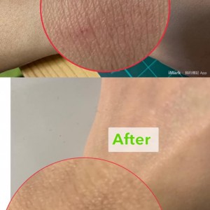 手背紅紅的, 有點脫皮, 怎麼處理?  (中國市場)