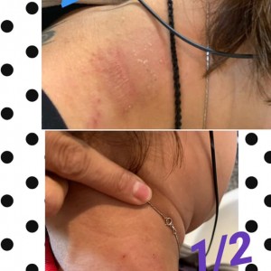 皮膚癢, 抓到出血出水, 可以用什麽精油舒緩呢? (* 中國市場)