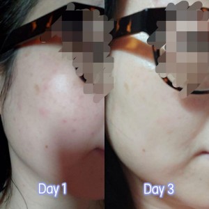 臉上突然出了粒粒，怎麽辦? *